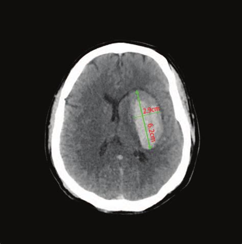 Head Computed Tomography Ct Scan Upon Admission Shows An