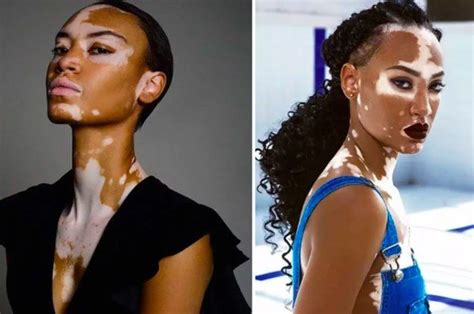 Covergirl Finally Featured A Model With Vitiligo And The Ad Is