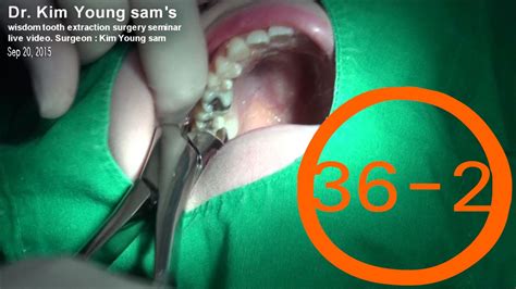 Extraction Of Upper Wisdom Tooth With Forceps By Dr Kim Young Sam 36 2