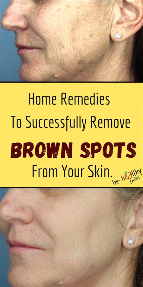 Ways To Get Rid Of Brown Spots On Facial Area Brownsunspots