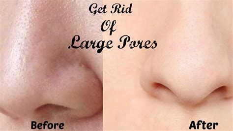 How To Get Rid Of Open Pores On Nose 3 Ways To Remove Blackheads On