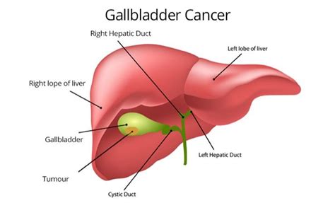 Maybe you would like to learn more about one of these? Signs To Look For When Dealing With Different Gallbladder ...