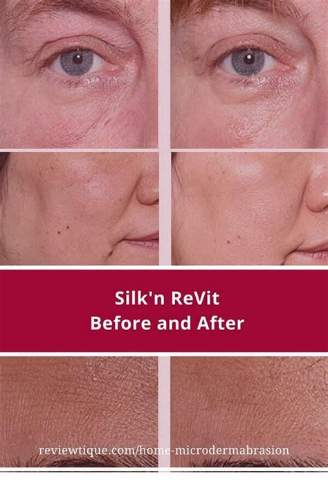 Microdermabrasion Before And After With Silkn Revit Results After Two