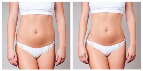 What To Expect After Liposuction Surgery Results From Before And