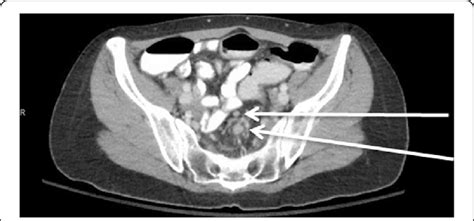 Preoperative Ct Scan Demonstrating Multiple Borderline Perirectal