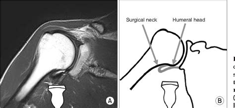 Figure 3 From Ultrasonographic Measurement Of The Thickness Of Axillary