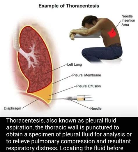 Thoracentesis Anatomy