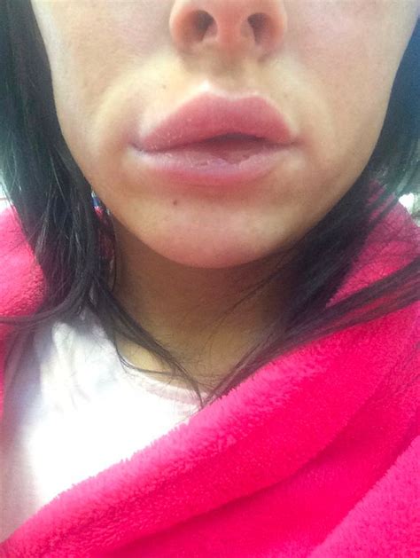 Woman Feared Shed Go Blind After Lip Exploded And Spread Filler Infection To Eye Mirror Online