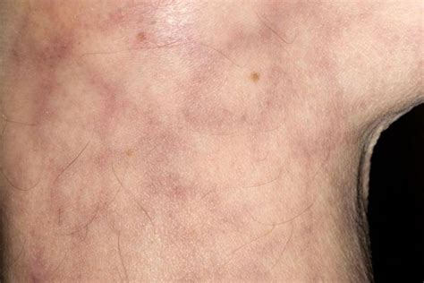 A Mottled Bluish Discoloration Of The Skin That Occurs In A Netlike