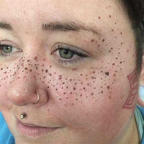 Not So Subtle Freckles If You Are A Tattoo Artist Or Permanent Makeup