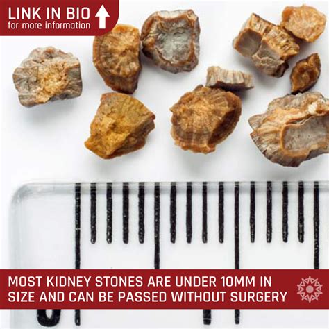4 Simple Steps To Naturally Passing Kidney Stones Passing Kidney