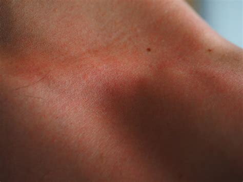 Free Photo Sunburn Skin Red Flushed Dermatology Burned Skin