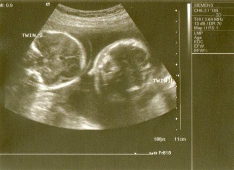 Ultrasound Shows Moment Twins Appear To Be Kissing In Womb