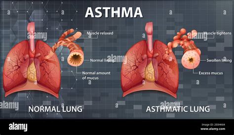 Bronchial Asthma Lung Hi Res Stock Photography And Images Alamy