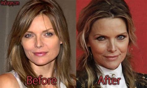 Michelle Pfeiffer Plastic Surgery Before After Photos
