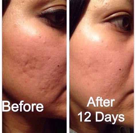 Most Effective Way To Get Rid Of Acne Scars Naturally Best Cream To