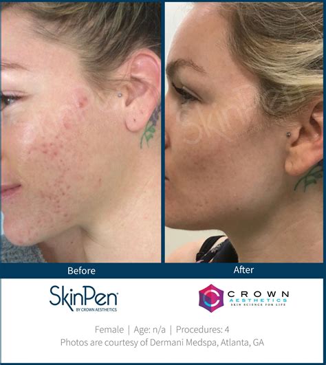Gsd Now Offers Skinpen A Microneedling Treatment Golden State