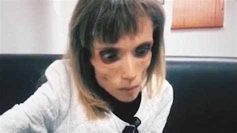 watch anorexic woman who weighs less than 3 stone mocked by doctors metro video