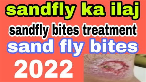 Sand Fly Sand Fly Bites Sandfly Bites Treatment In Urdu Sand Fly Bites On Humans Youtube