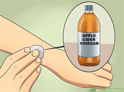 How To Treat Ringworm With Pictures Wikihow