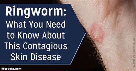 What Do You Know About Ringworm Ramsey Nj Patch