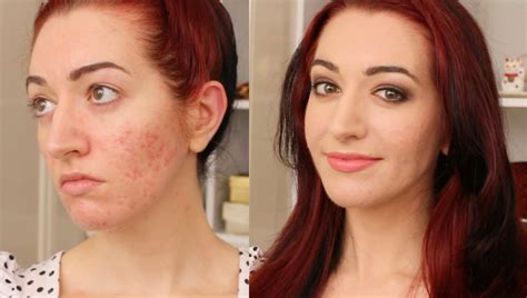 How To Cover Deep Acne Scars