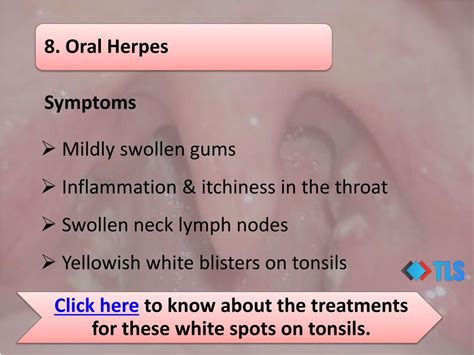 Ppt 8 Causes Of White Spots On Tonsils You May Not Know Powerpoint