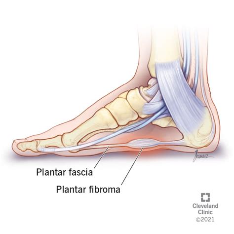 Best Shoes For Plantar Fibroma Savvy About Shoes