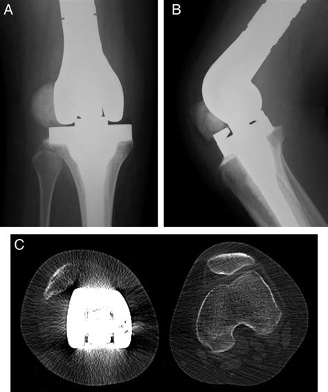 Patella Dislocation Following Distal Femoral Replacement After Bone