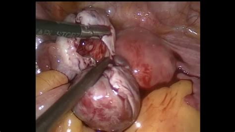 Bilateral Ovarian Dermoid Cyst Youtube