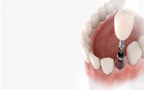 Dental Implant Osseointegration What To Expect Nha Khoa Sydney
