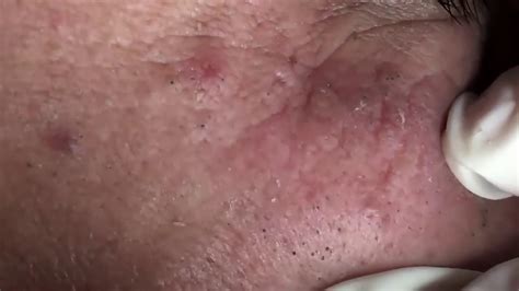 Satisfying Blackheads Extraction On The Face New Youtube