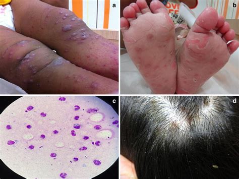 Dermatologic Findings Of Unusual Hfmd A Varicelliform Lesions B