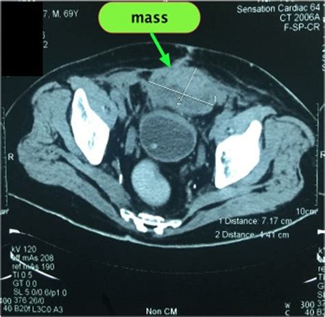 3 Month Follow Up Ct Scan Sagittal View Showed Mass In The Abdomen