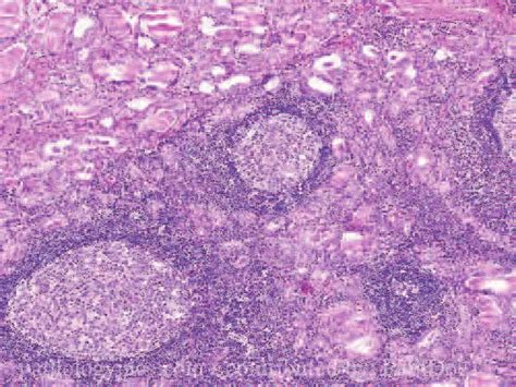 Histological Section Thyroid Gland Affected With Hashimotos Disease