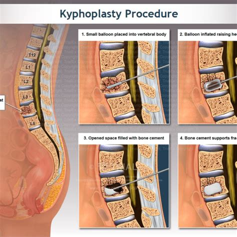 Kyphoplasty Procedure Trialexhibits Inc