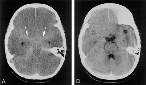 Pseudo Subarachnoid Hemorrhage A Potential Imaging Pitfall Associated
