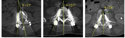 The Transverse Or Medio Lateral Angulation Of Pedicle Screw Placement Download Scientific