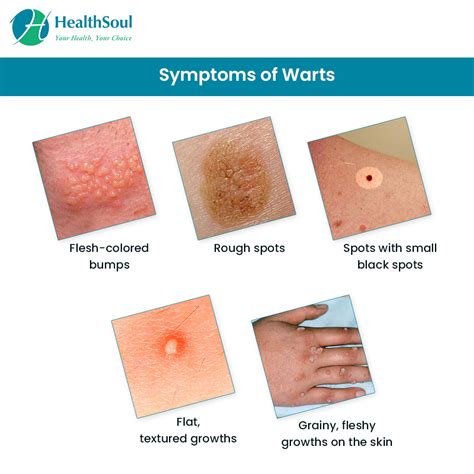 Warts Skin Growth Due To Clogged Blood Vessels Healthsoul