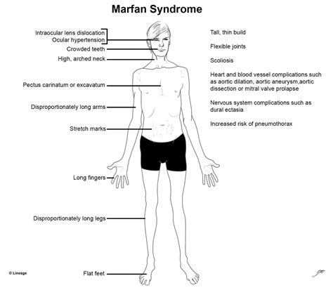 Marfan Syndrome Genetics Symptoms Diagnosis And Treatment Online Biology Notes