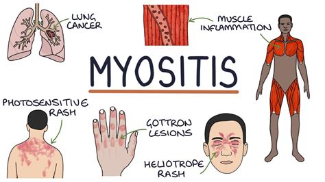 Understanding Myositis Polymyositis And Dermatomyositis Youtube