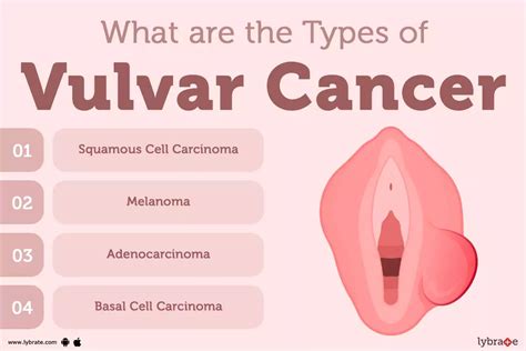 Vulvar Cancer Symptoms Causes Treatment Off