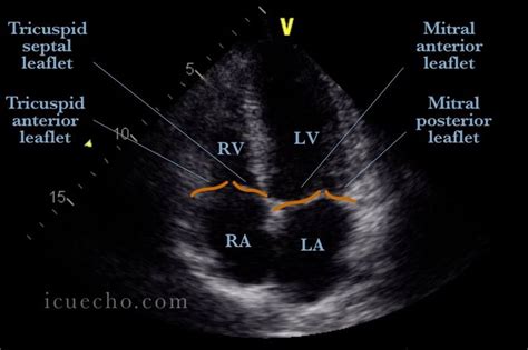 Apical 4 Chamber Icu And Echo Cardiac Sonography Tricuspid Valve Echo