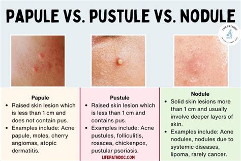 Papule Vs Pustule Vs Nodule Pictures Differences And Causes