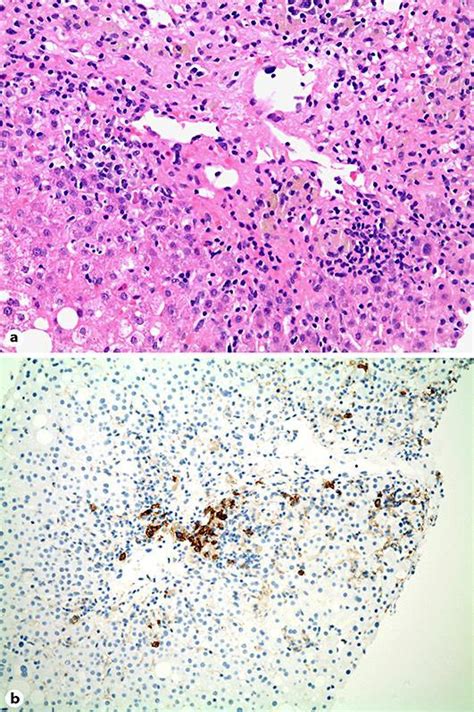 A Liver Biopsy Specimen Showing Severe Hepatitis With Centrilobular