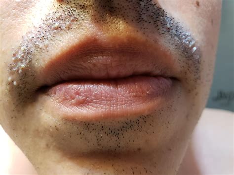 Plagued With Mustache Pimples For Months On End Help Wickededge
