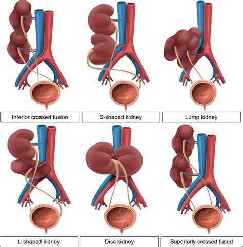 Congenital Anomalies Of The Upper Urinary Tract A Comprehensive Review Radiographics