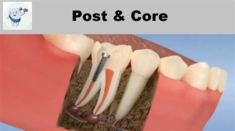 Post And Core After Root Canal Treatment Youtube