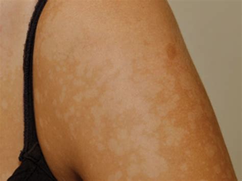 Tinea Versicolor Pictures Treatment Causes Contagious Symptoms