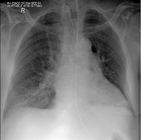 Accidental Pneumothorax From A Nasogastric Tube In A Vrogue Co